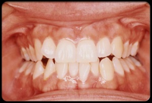19-habits-that-wreck-your-teeth-s5-photo-of-clenched-teeth