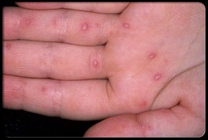 childhood-illnesses-s6-hand-foot-mouth-disease