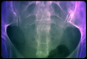 sciatica-s10-photo-of-pelvis-xray