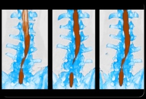 low-back-pain-s10-spinal-mri